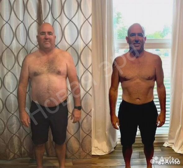 Минус 5 см за одну процедуру. Криолиполиз