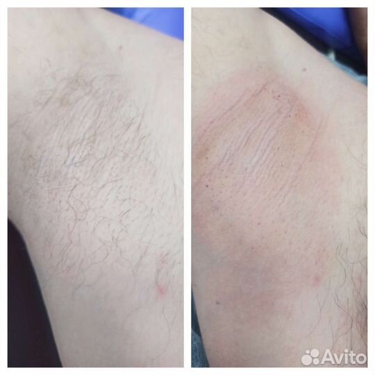 Депиляция воском мужская /женская