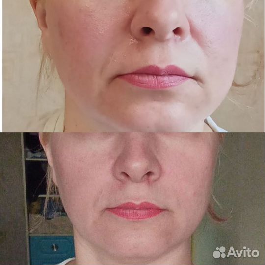 Чистка лица,процедура фарфоровая куколка