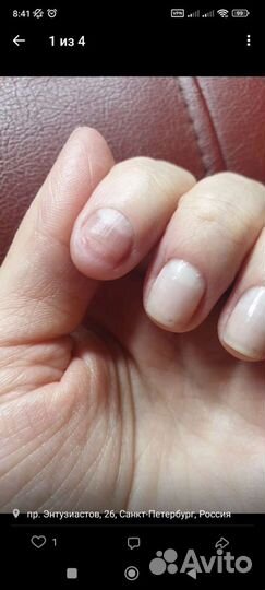 Реальное лечение грибка и вросших ногтей