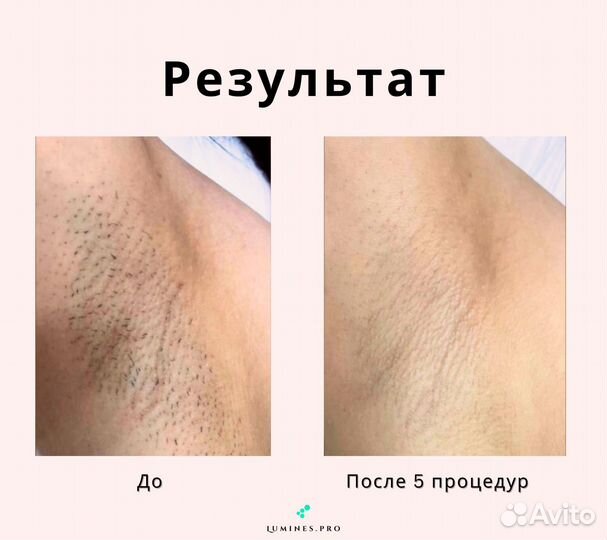 Аппарат для эпиляции люминес Макс Ван 1200W