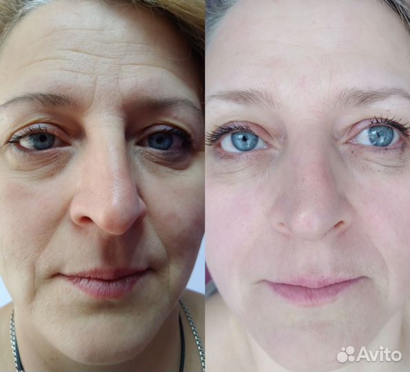 Лифтинг массаж лица