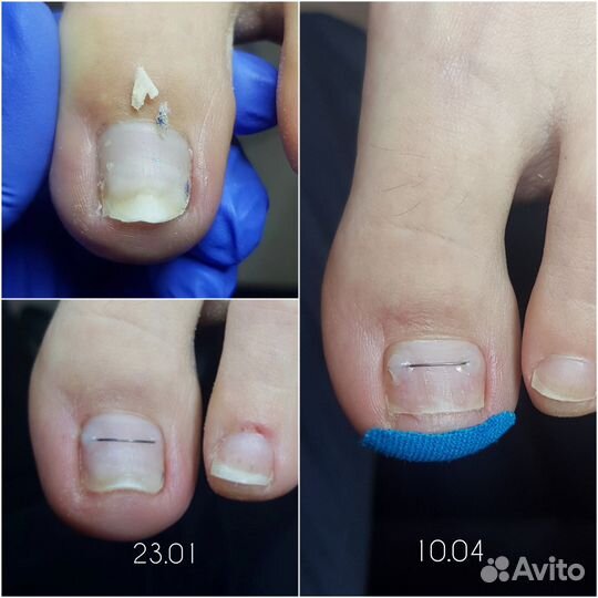 Подолог, медицинский педикюр