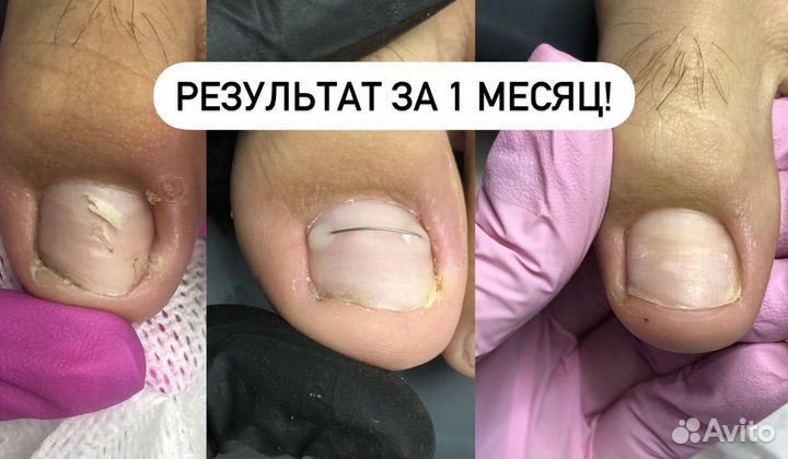 Подолог.Медицинский педикюр.Титановая нить