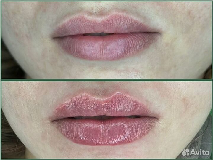 Контурная пластика губ