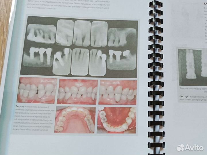 Периимплантит