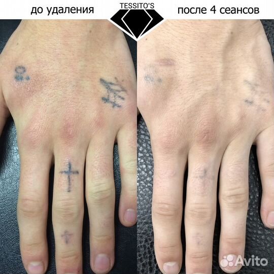 Удаление тату