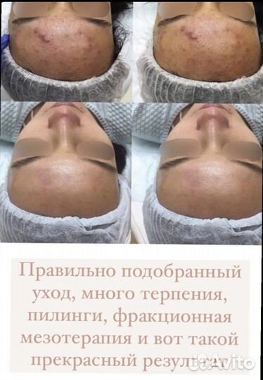 Косметолог чистка лица лечение акне