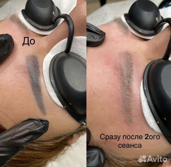 Лазерное удаление тату и татуажа