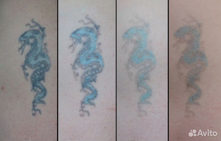 Лазер для удаления татуировок