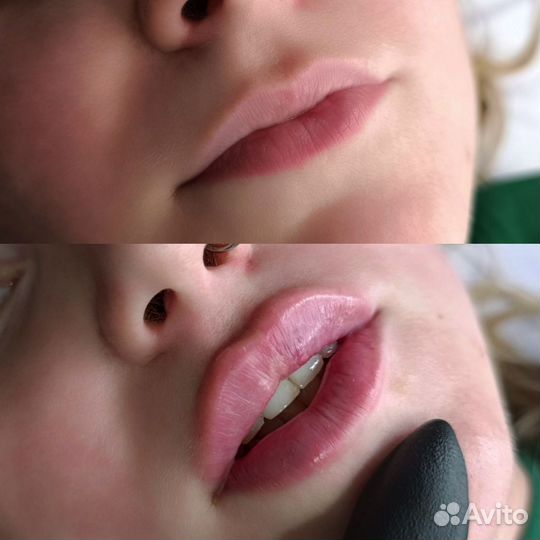 Косметолог/чистка лица/увеличение губ/ботокс/нити