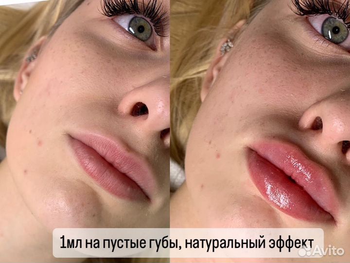 Увеличение губ без боли