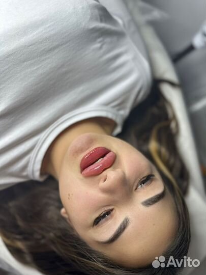 Увеличение губ