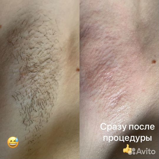 Электроэпиляция Apilus Удаление папиллом,звездочек