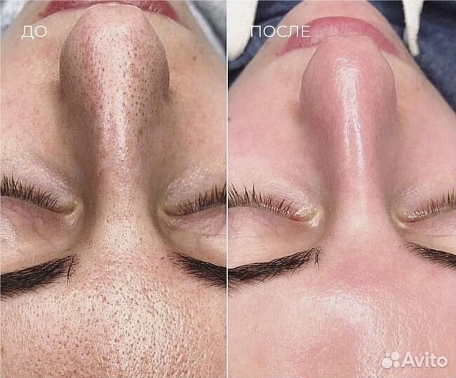 Чистка лица