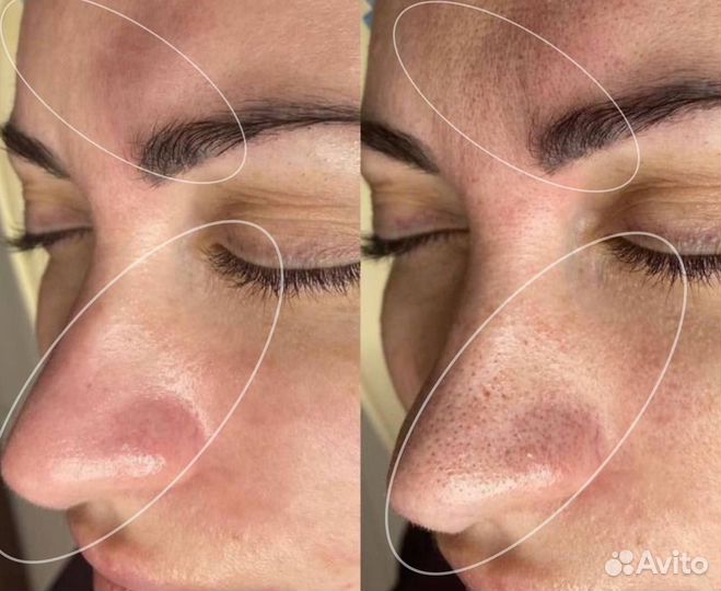 Чистка лица глубокий пилинг в подарок