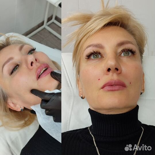 Контурная пластика губ