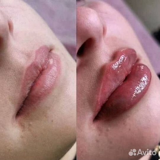 Модель на увеличение губ