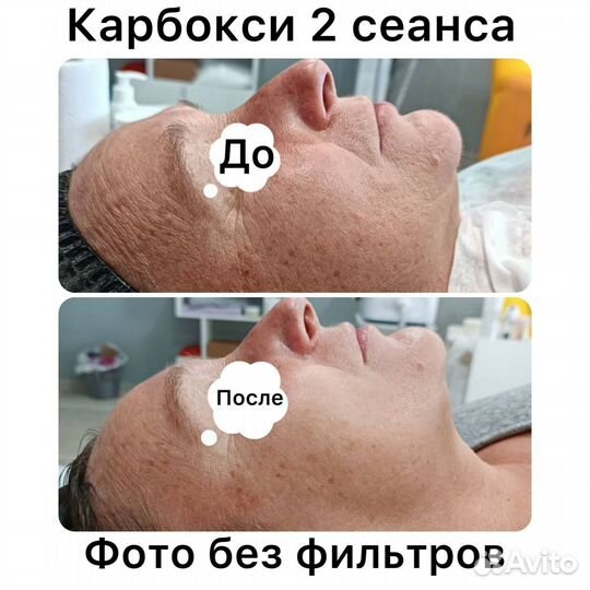 Ищу модель карбокситерапия