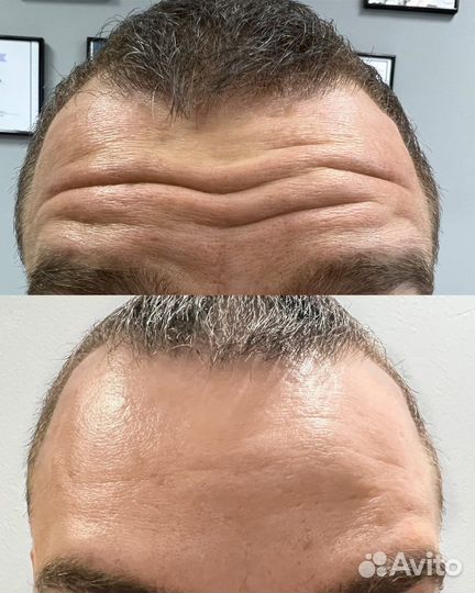 Ботулинотерапия