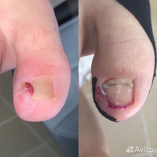 Лечебный педикюр подолог