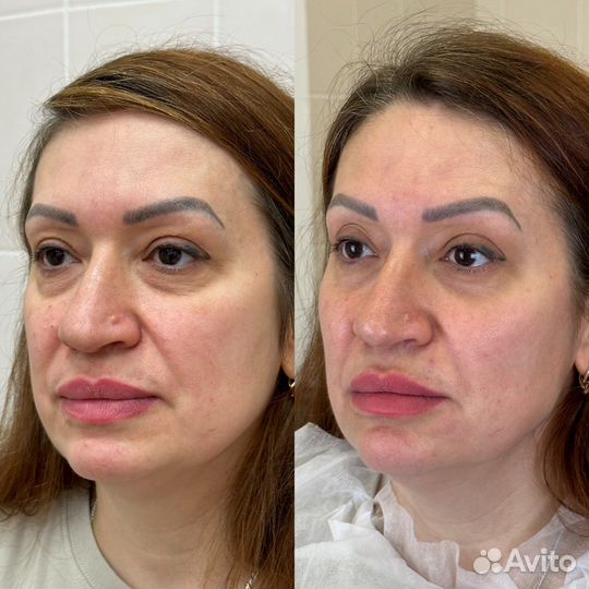 Lumecca фототерапия фотоомоложение