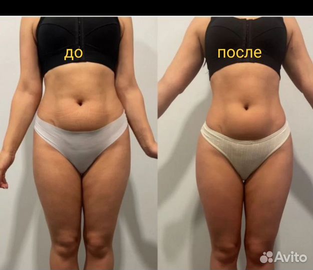 Индиба терапия/похудение/подтяжка кожи/лечение