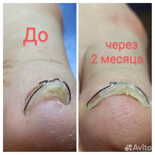 Коррекция ногтевой пластины (вросший ноготь)