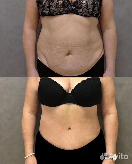 Лазерная липосакция