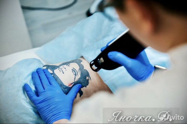 Удаление & Карбоновый пилинг спб