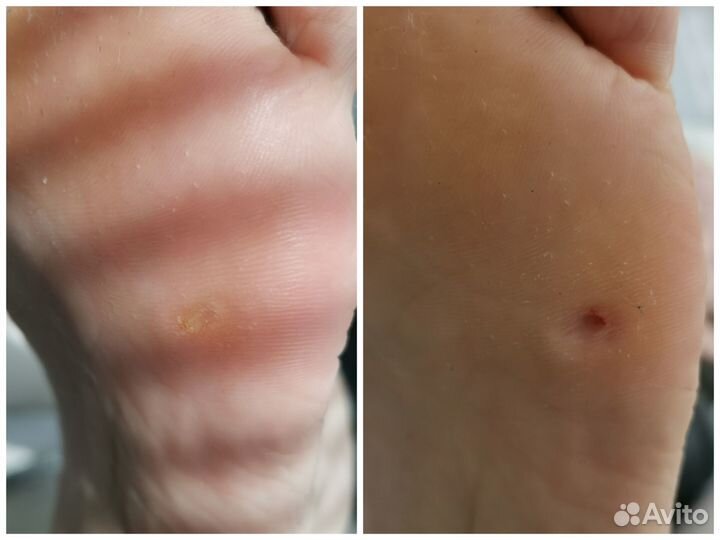 Подолог. Педикюр(грибок,вросший ноготь и др)