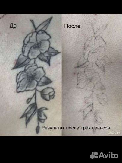 Удаление татуировоки и перманентного макияжа