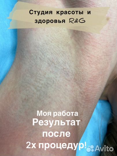 Электроэпиляция/Шугаринг