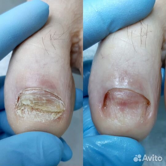 Подолог с выездом на дом