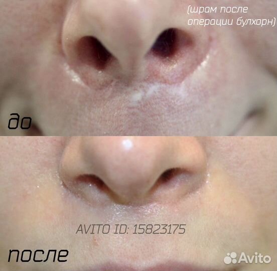 Удаление шрамов Камуфляж рубцов растяжек витилиго