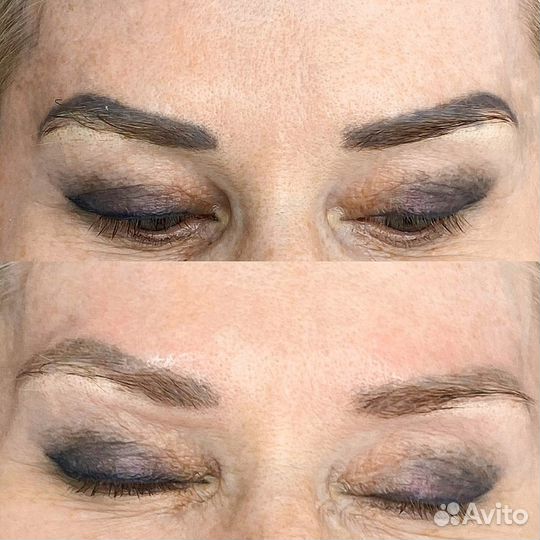 Удаление татуажа и удаление тату