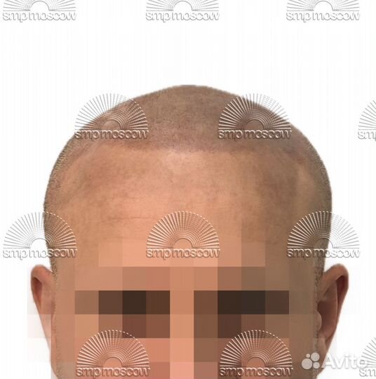 Имитация волос (фолликул), трихопигментация, smp