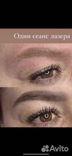 Удаление тату и татуажа лазером