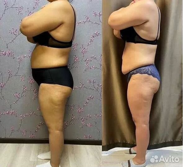 Удаление жира, криолиполиз в Курске