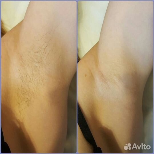 Восковая депиляция и шугаринг