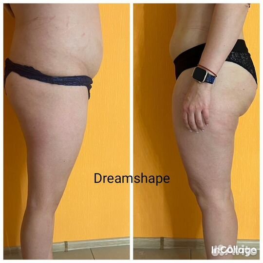 Аппаратный,вибрационно-роликовый массаж,кавитация