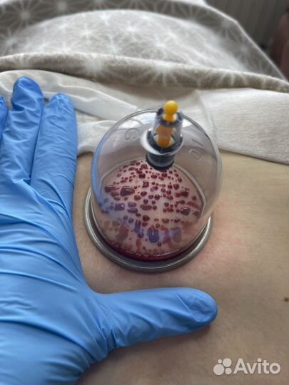 Хиджама. Обучение. Сертифицированный тренер