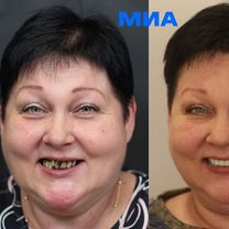 Полная имплантация челюсти На 40+ лет Рассрочка, Москва