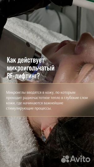 Микроигольчатый RF-лифтинг