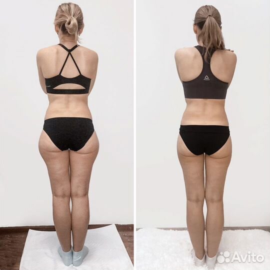 Коррекция фигуры безоперационная липосакция