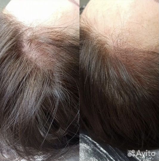 Трихопигментация, загущение волос