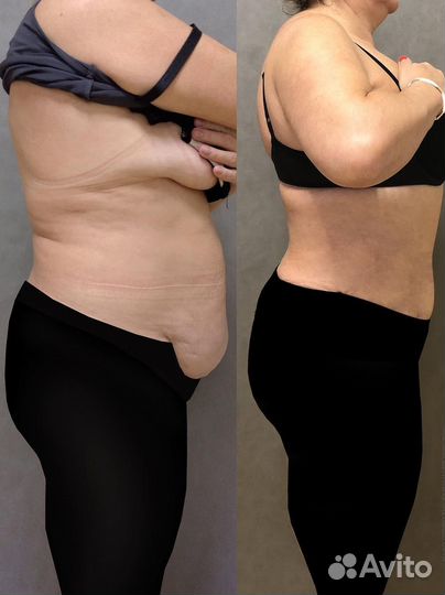 Лазерная липосакция