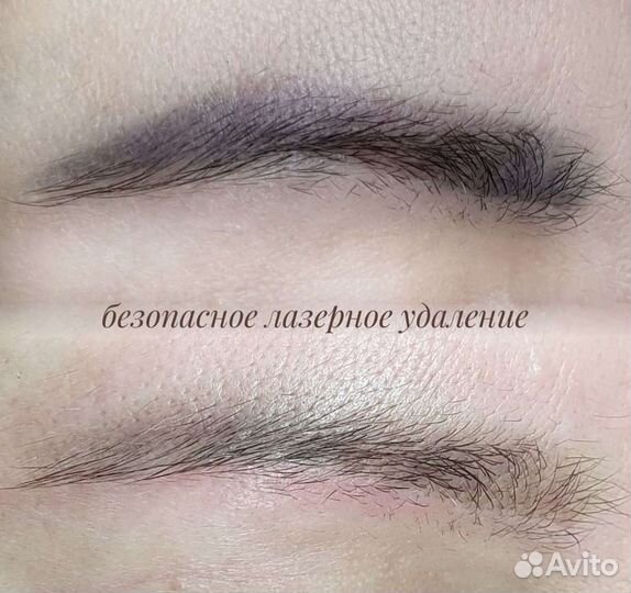 Удаление татуажа