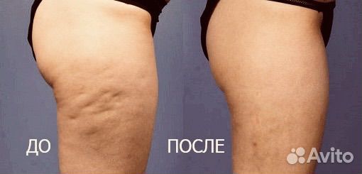 Массаж коррекция фигуры