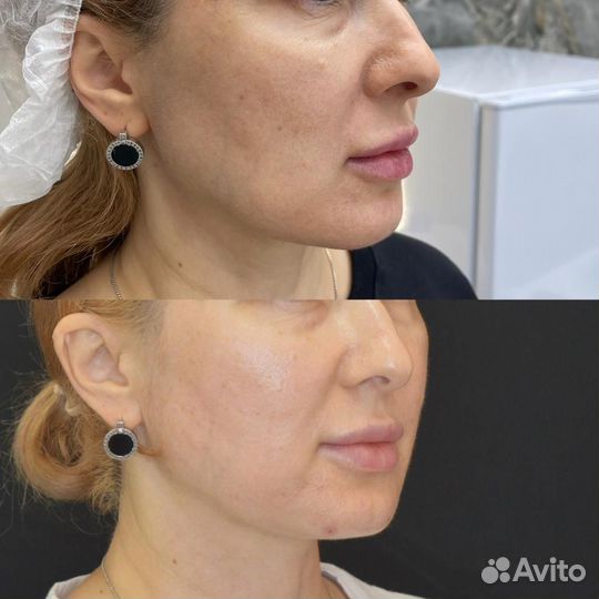 Услуги косметолога лифтинг нитями и аппаратный